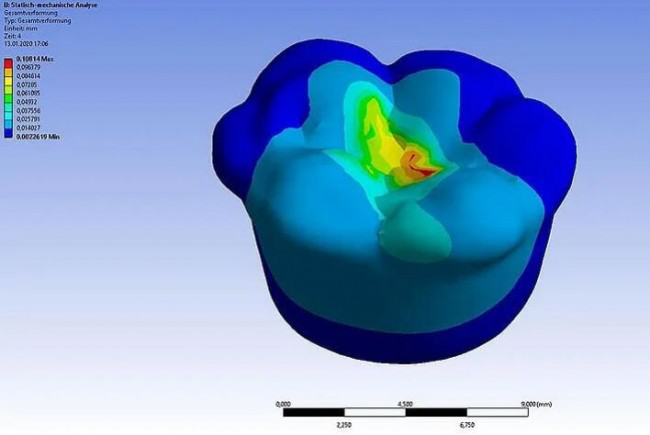 3D打印陶瓷牙齿