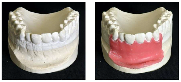 3D打印手术模型