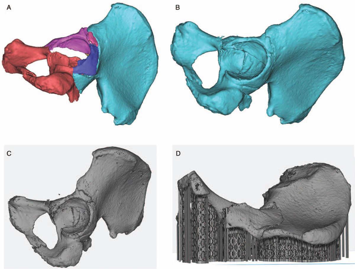   骨折碎片的3D模型