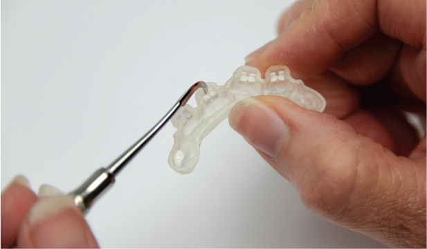 3D打印正畸牙套