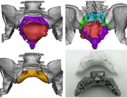 3D打印医疗