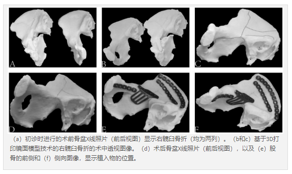 3D打印的医学模型修复骨折