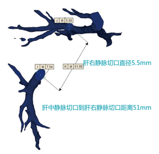 3D打印医疗