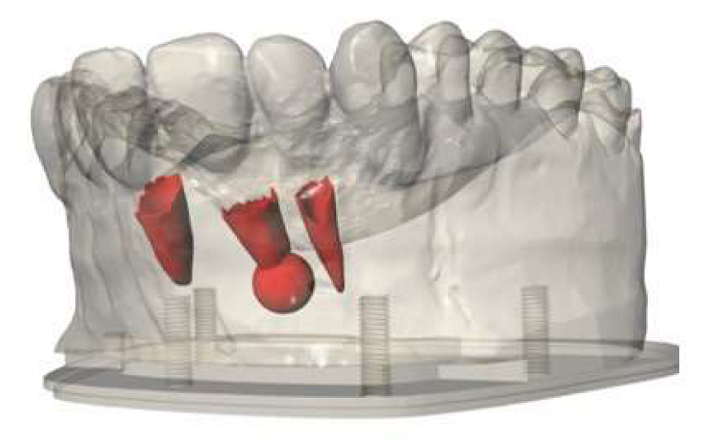 3D打印手术模型