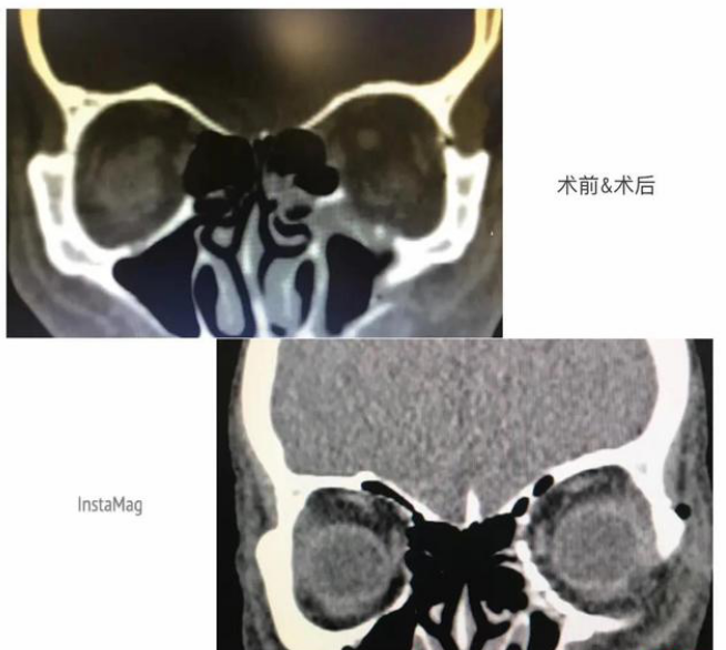 手术前后对比